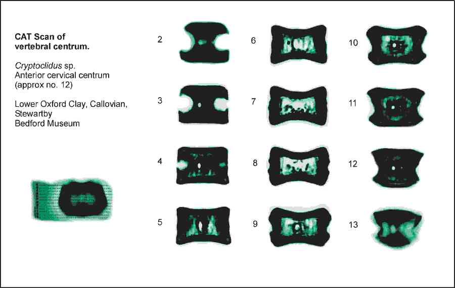 CAT Scan of cervical centrum